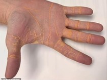 Kacau! 5 Orang Ini Alami Efek Samping Ekstrem Usai Terlalu Banyak Makan