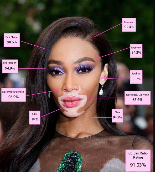 5. Winnie Harlow   Meski memiliki kondisi kulit vitiligo, kecantikan wajah Winnie Harlow tetap stand out. Selain menantang norma kecantikan, Winnie juga punya proporsi wajah hampir sempurna bahkan untuk bagian dahinya.   Foto: Dok. Blog Dr. Julian De Silva