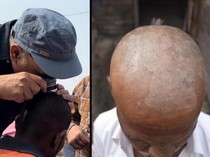 Misteri Kerontokan Rambut Massal Menimpa Penduduk Desa di India