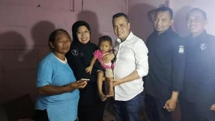 Polda DIY bantu pengangkatan tumor balita Ningsih. (Dok. ist)