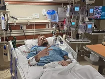 Petaka Masak Pasta, Kaki Pria Ini Diamputasi