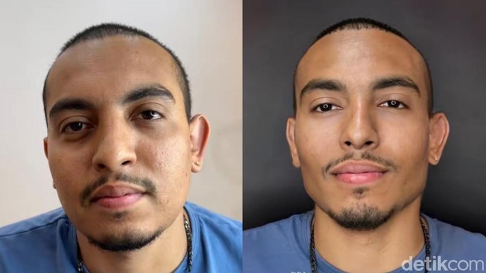 Transformasi Wajah Pria usai Operasi Plastik, Tampak Lebih Muda seperti Beda Orang