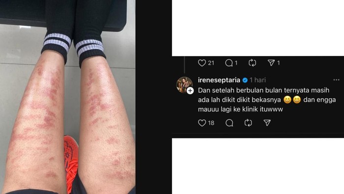 Kata Dermatolog soal Viral Kaki Wanita Melepuh usai Perawatan IPL Bulu Kaki