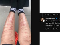 Kata Dermatolog soal Viral Kaki Wanita Melepuh usai Perawatan IPL Bulu Kaki