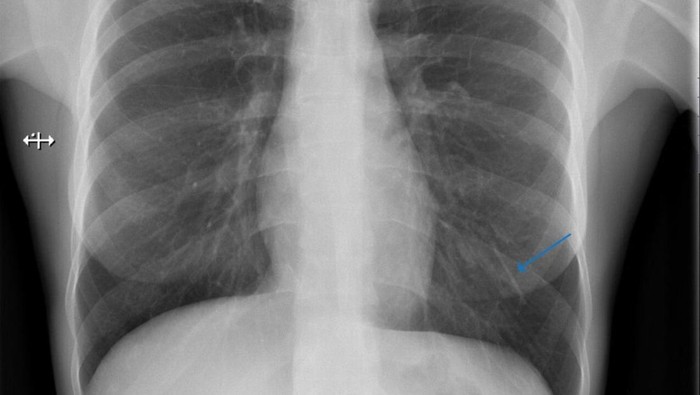 KB Implan di Lengan Mendadak Hilang, Tak Tahunya Nyasar ke Paru-paru