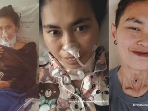 Cerita Wanita Salatiga Kena Kanker Laring Stadium 3, Sempat Dikira Radang Tenggorokan