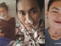 Awal Mula Wanita Salatiga Kena Kanker Laring Stadium 3, Ini Gejala yang Dialami