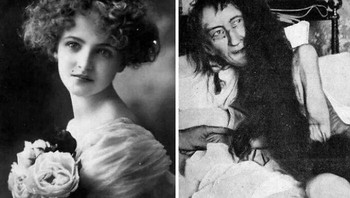 Gadis yang Hilang, 1874 Blanche Monnier Adalah Seorang Sosialita Paris, Dikenal Karena Kecantikannya. Dia ingin menikahi seorang pengacara tua yang tidak disetujui ibunya, jadi dia menguncinya di sebuah kamar kecil dan gelap di lotengnya selama 25 tahun. Yang kiri diambil pada tahun 1870-an, yang kanan pada tahun 1901 setelah dia ditemukan. Foto: Boredpanda