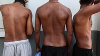 Warga negara Ethiopia Berihun (28), Tsinat (26), dan Sisay (28), menunjukkan luka-luka yang mereka alami setelah disiksa dengan sengatan listrik dan pukulan ketika mereka tidak dapat mencapai target yang ditugaskan kepada mereka.