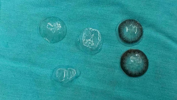 Dokter Syok Temukan 5 Lensa Kontak Nyangkut di Mata Pasien, Ketahuan gegara Ini