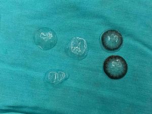 Dokter Syok Temukan 5 Lensa Kontak Nyangkut di Mata Pasien, Ketahuan gegara Ini