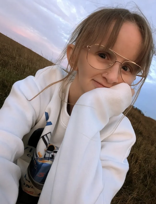 Lyndsey, yang kini berusia 23 tahun, mengalami kondisi fisik yang tidak biasa akibat kanker langka yang dideritanya saat masih kecil. Di usia lima tahun, ia didiagnosis mengidap rhabdomyosarcoma, sejenis kanker jaringan lunak yang menyerang kelenjar pituitari di belakang mata kirinya Foto: Instagram