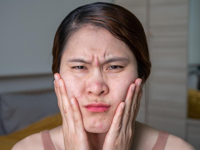 Perbedaan Bruntusan dan Jerawat