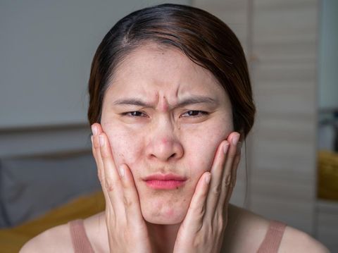 Perbedaan Bruntusan dan Jerawat Perbedaan Bruntusan dan Jerawat