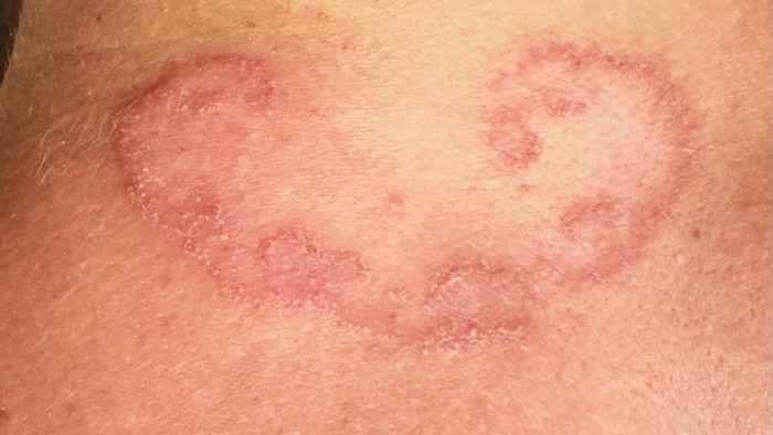 Dikira Ruam Biasa, Ternyata Ada Cacing Parasit Bersarang di Bawah Kulit Remaja Ini