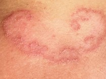 Dikira Ruam Biasa, Ternyata Ada Cacing Parasit Bersarang di Bawah Kulit Remaja Ini