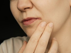 8 Cara Mengatasi Pinggir Bibir Luka dan Kering Saat Puasa