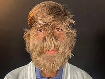 Video: Hipertrikosis, Kondisi yang Diidap Pria dengan Wajah Paling Berbulu Sedunia