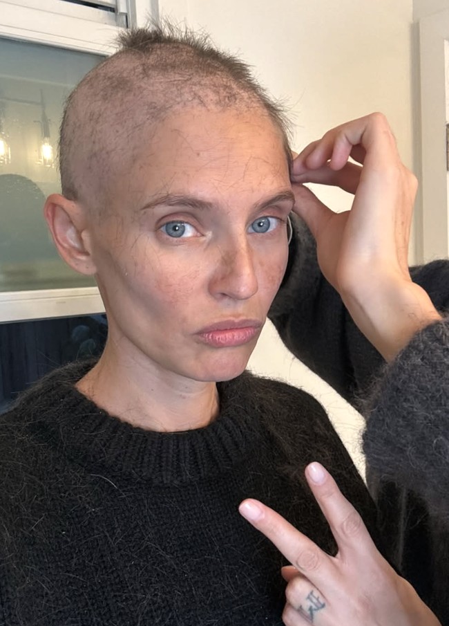 Bianca memulai kemoterapi pada 14 Oktober 2024 dan resmi menyelesaikannya pada 27 Januari 2025. Selama proses kemoterapi, Bianca kehilangan seluruh rambut, alis, dan bulu matanya. Namun, alih-alih terpuruk, ia memilih mencukur seluruh rambutnya.  Foto: dok. Instagram @biancabalti