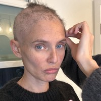 Bianca memulai kemoterapi pada 14 Oktober 2024 dan resmi menyelesaikannya pada 27 Januari 2025. Selama proses kemoterapi, Bianca kehilangan seluruh rambut, alis, dan bulu matanya. Namun, alih-alih terpuruk, ia memilih mencukur seluruh rambutnya.  Foto: dok. Instagram @biancabalti