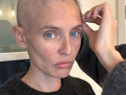 Kisah Model Sakit Kanker Ditolak Tampil di Victorias Secret Fashion Show