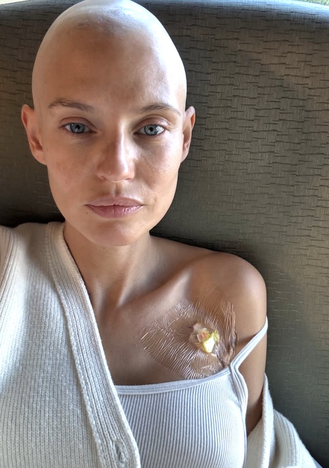 Bianca Balti, supermodel asal Italia yang dikenal lewat berbagai pemotretan ikonik untuk majalah Sports Illustrated, kini mencuri perhatian dunia dengan penampilan barunya. Bianca yang selama ini berjuang dengan kanker ovarium stadium 3C kini tampil botak. Foto: dok. Instagram @biancabalti