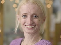 Idap Penyakit Langka, Wanita Ini Menua 10 Kali Lebih Cepat dari Manusia Normal