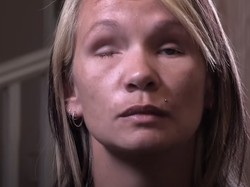 Kisah Tragis Tina: Disiksa Kekasih Hingga Buta, Kini Hidup Dalam Ketakutan