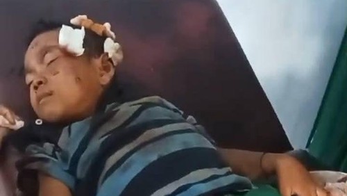 Korban gigitan anjing rabies di Dompu, Nusa Tenggara Barat (NTB).