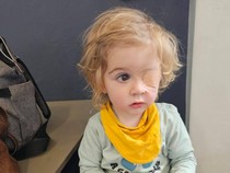 Bocah 2 Tahun Buta Sebelah usai Tertular Herpes, Diduga gegara Dicium Orang Lain