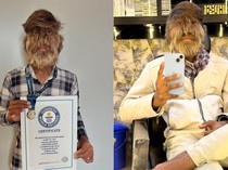 Remaja India Ini Dinobatkan sebagai Pria dengan Wajah Paling Berbulu di Dunia