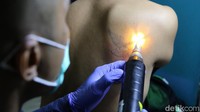 Ada sejumlah tahapan yang harus diikuti peserta sebelum mereka menjalani hapus tato menggunakan laser, yakni registrasi, cek kesehatan (lab darah), dan konsultasi dokter.   