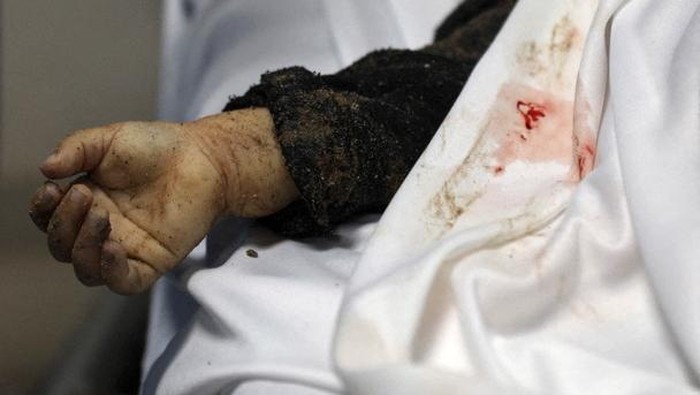 SENSITIVE MATERIAL. THIS IMAGE MAY OFFEND OR DISTURB    A Palestinian casualty lies on a mattress at the Indonesian hospital following an Israeli strike, in the northern Gaza Strip March 19, 2025. REUTERS/Abd Elhkeem Khaled