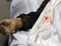 Dokter di Gaza Ungkap Kondisi Pasien-RS Imbas Serangan Israel, Sebut Bak Kiamat