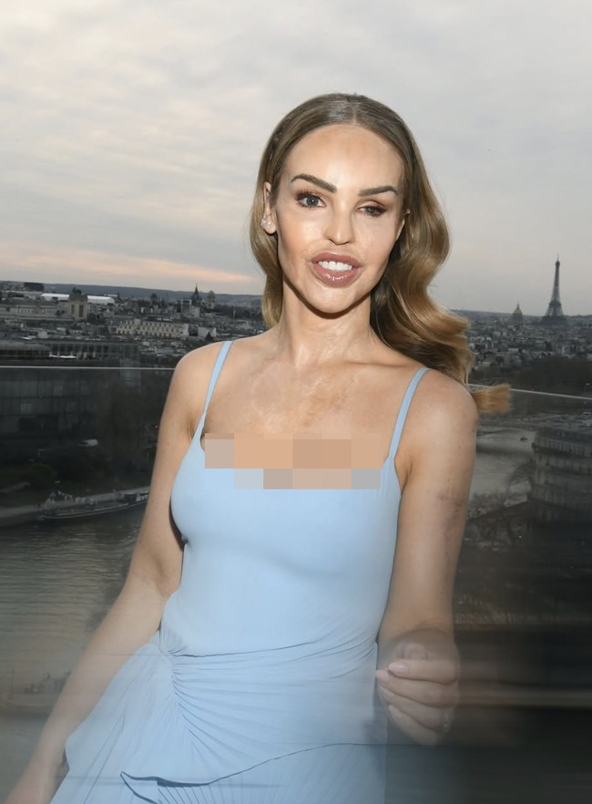 Sebagai seseorang yang mengalami luka bakar parah akibat serangan air keras, ia telah berjuang untuk menerima kulitnya apa adanya. Baginya, kecantikan sejati tidak hanya terletak pada fisik, tetapi juga pada ketangguhan dan kepercayaan diri. Foto: dok. Instagram @katiepiper_