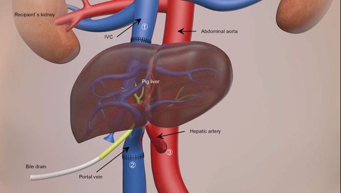 Transplantasi hati babi