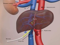 Ilmuwan China Transplantasi Hati Babi ke Manusia, Hidup 171 Hari!
