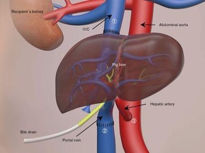 Ilmuwan China Transplantasi Hati Babi ke Manusia, Hidup 171 Hari!