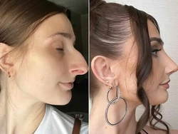 Jadi Makin Cantik, Wanita Ini Ceraikan Suami Usai Jalani Rhinoplasty