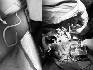 Ngilu, Dokter di Jember Keluarkan Cacing Hidup di Perut Bocah 3 Tahun