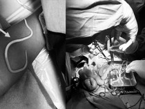 Awal Mula Temuan Cacing Hidup di Perut Bocah Umur 3 di Jatim, Ini Pemicunya