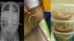 Momen Dokter Temukan Cacing Hidup di Tubuh Manusia, Foto-fotonya Bikin Merinding