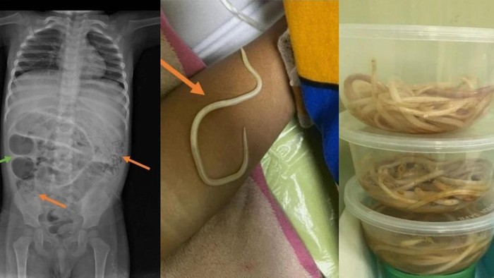 Cacing bersarang di perut bocah 3 tahun Cacing bersarang di perut bocah 3 tahun