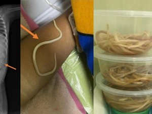 Bocah 3 Tahun di Jember Mengeluh Susah BAB, Ternyata Ususnya Dipenuhi Cacing