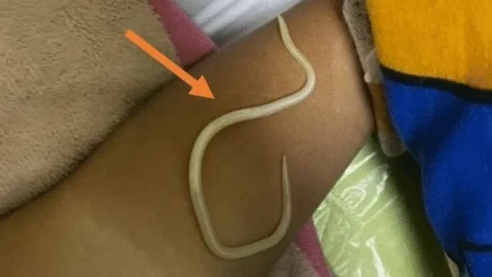 Cacing hidup di perut bocah 3 tahun di Jatim