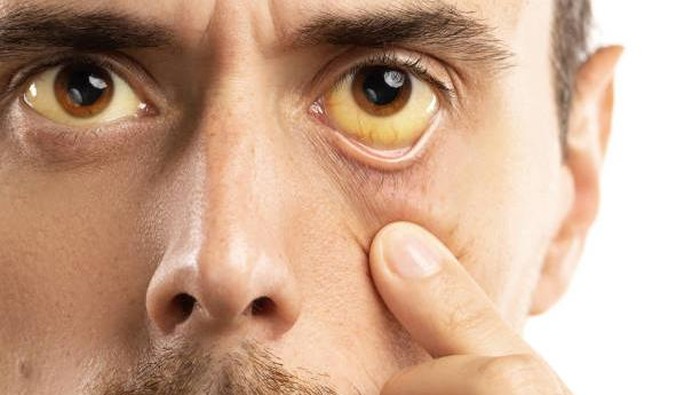 5 Cara Memutihkan Bola Mata yang Kuning Secara Alami