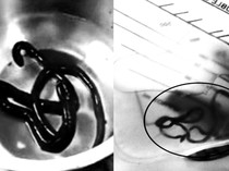 Ada Cacing Bersarang di Ginjal Pria India, Kebiasaan Sepele Ini Jadi Pemicunya