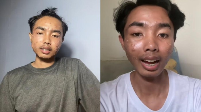 Bikin Pria Sakit Kulit, Dokter Soroti Penularan Penyakit dari Baju Thrifting