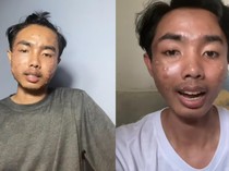 Viral Pria Idap Sakit Kulit di Wajah gegara Pakai Baju Thrifting Tanpa Cuci