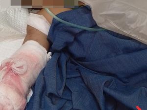 Jari Tangan Balita Bima Terancam Cacat Diduga Berawal dari Jarum Infus
